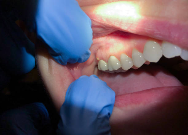 Best Emergency Tooth Extraction in USA